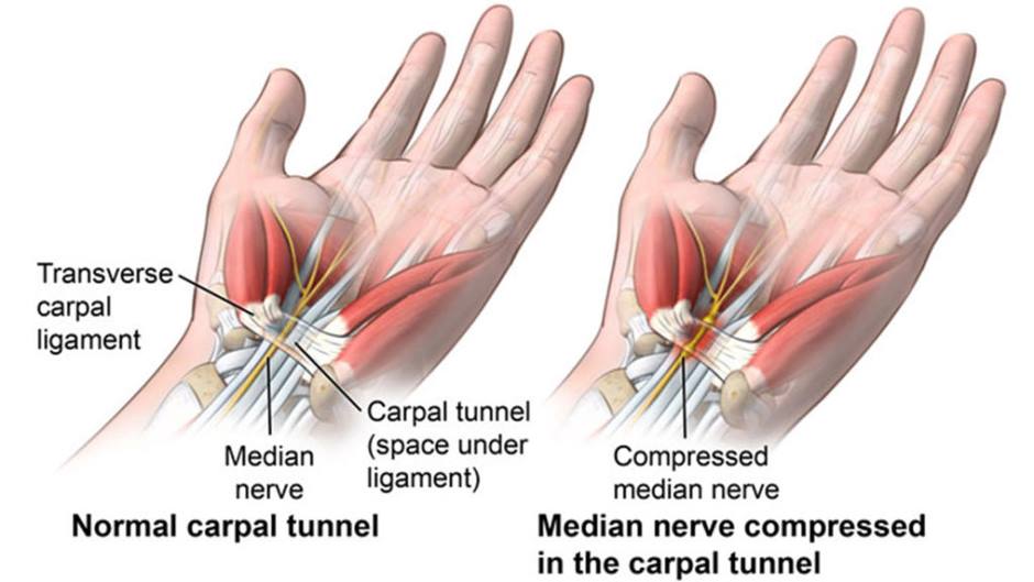 Carpal Tunnel Syndrome Treatment