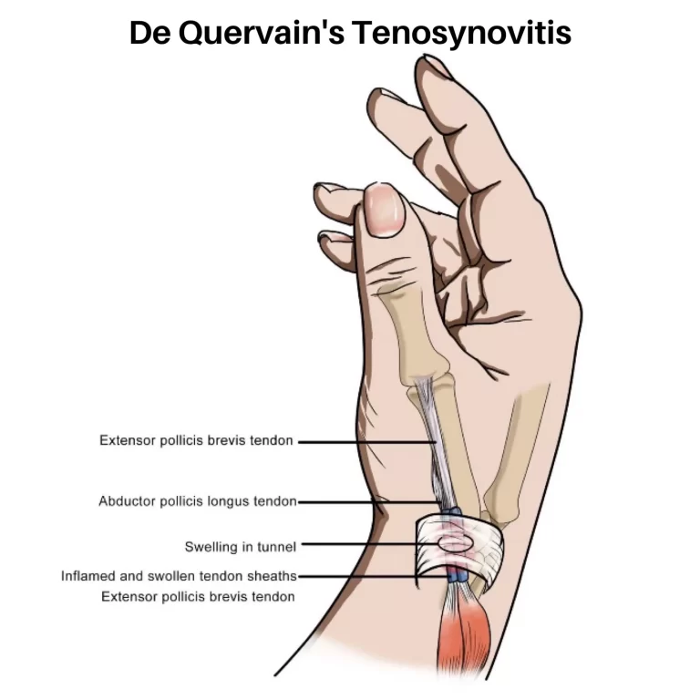 De Quervain's Tenosynovitis | Orchard Health Clinic