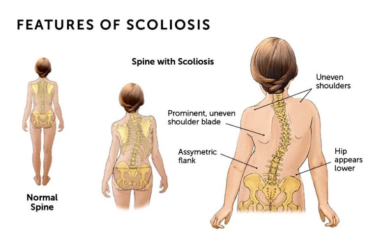 Scoliosis | Orchard Health Clinic