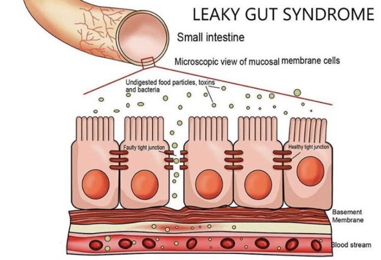 Image of Leaky Gut Syndrome | Orchard Health Clinic