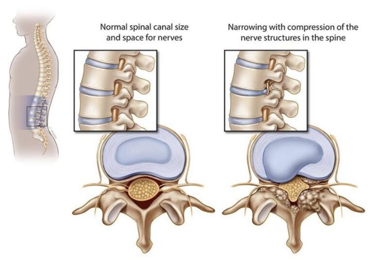 An illustration showing normal spinal canal size and space for nerves