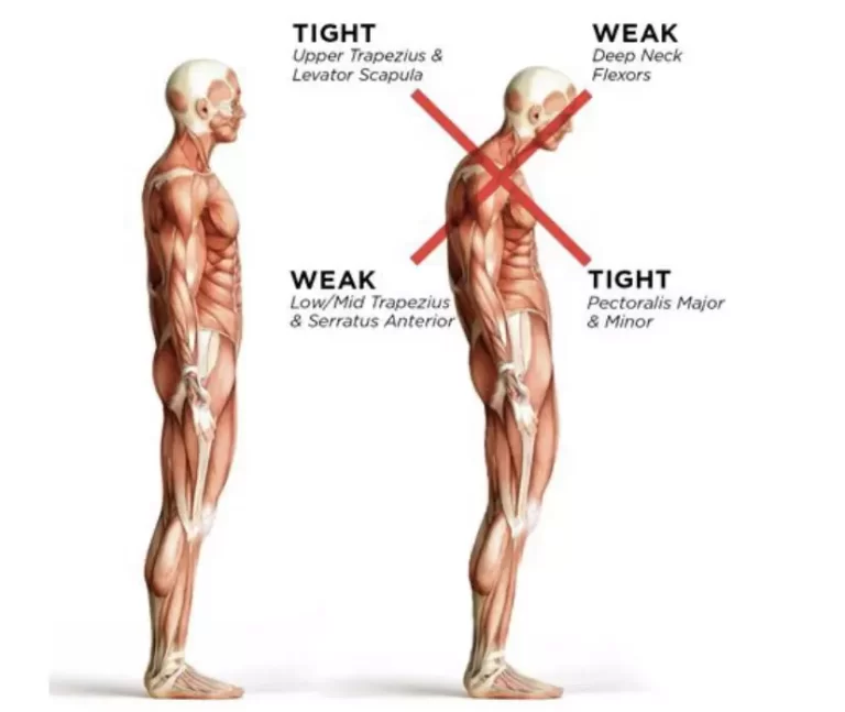 OHC Truths #02 How Does Your Posture Lead To Disc Issues | Orchard Health Clinic