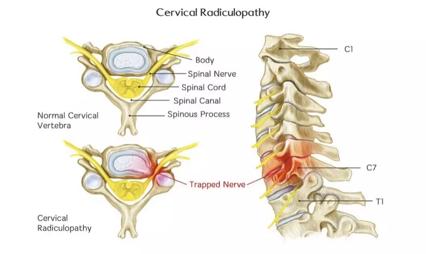 OHC Truths #03 Is Your Arm Pain Actually A Neck Problem (Cervical Radiculopathy) | Orchard Health Clinic