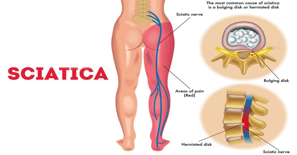 Sciatica | Orchard Health Clinic