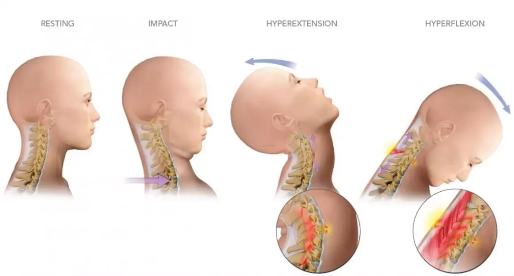 Whiplash | Orchard Health Clinic