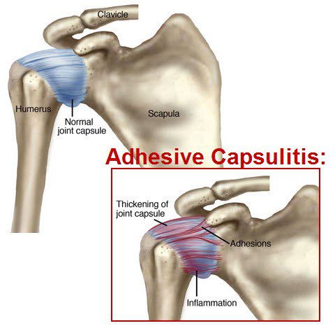 Anatomy Frozen Shoulder | Orchard Health Clinic