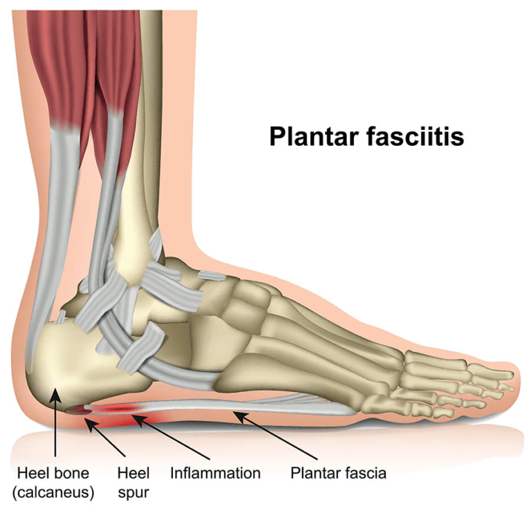 Plantar Fasciitis Illustration | Orchard Health Clinic