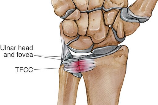 Triangular Fibrocartilage Complex (TFCC) | Orchard Health Clinic