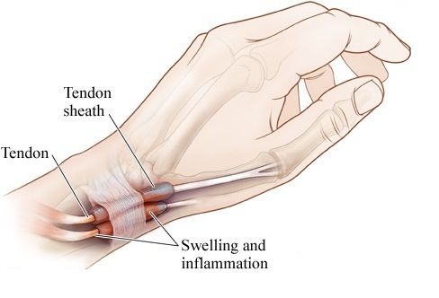 Wrist Tendon Injury | Orchard Health Clinic