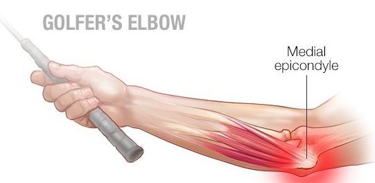 Golfer's Elbow | Orchard Health Clinic