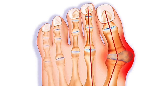 Bunions | Orchard Health Clinic