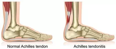 Achilles Tendonitis | Orchard Health Clinic