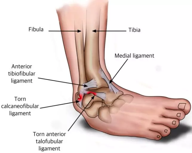 Ankle Sprains | Orchard Health Clinic