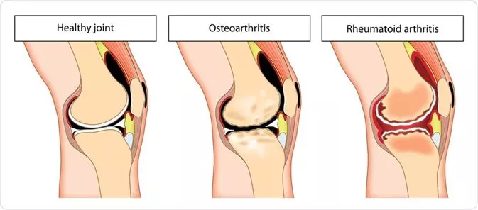 Arthritis | Orchard Health Clinic