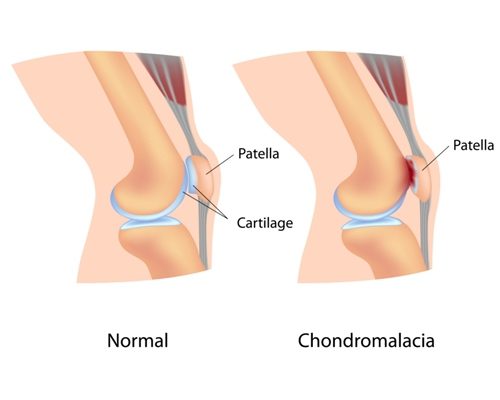 Chondromalacia Patella - Kinesio