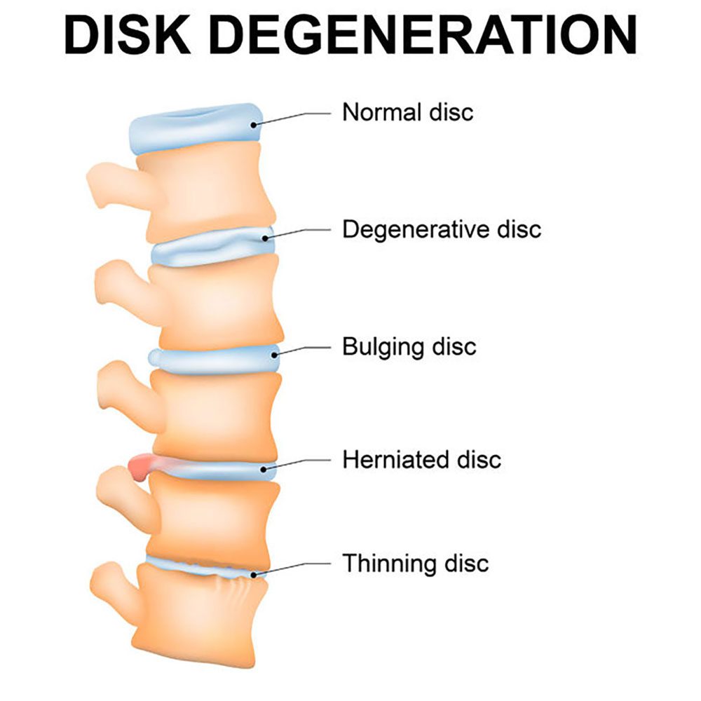 image of Degenerative-Disc-Disease