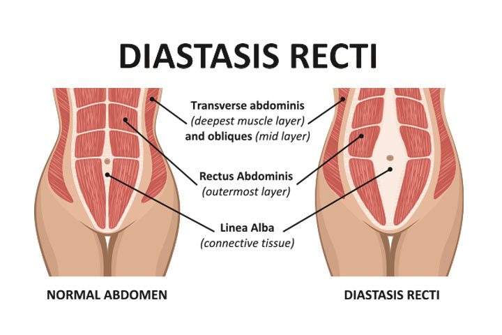 diagram of Diastasis-Recti