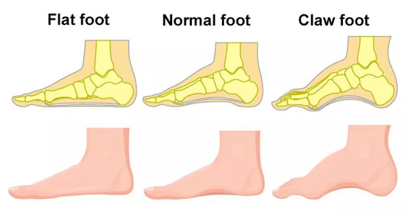 Flat Feet