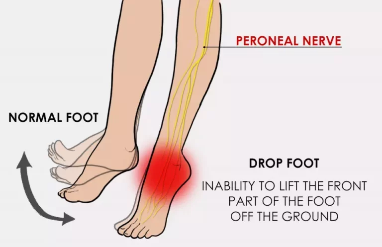 Foot Drop | Orchard Health Clinic