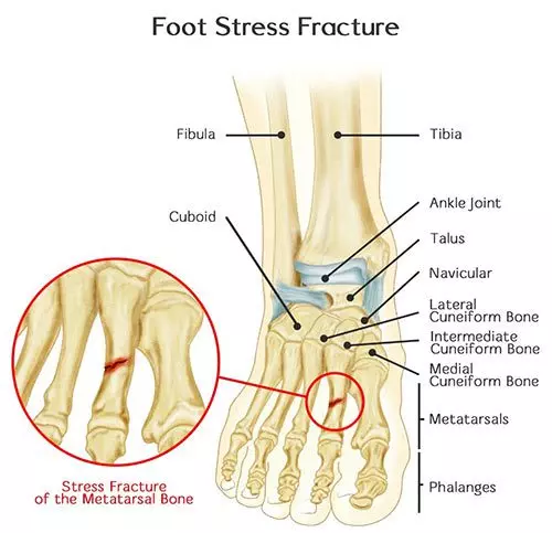 Foot Fracture