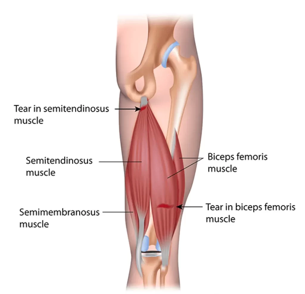 Hamstring Tear Strain | Orchard Health Clinic