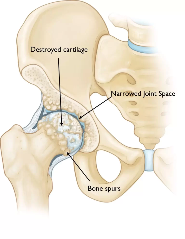 Hip Arthritis