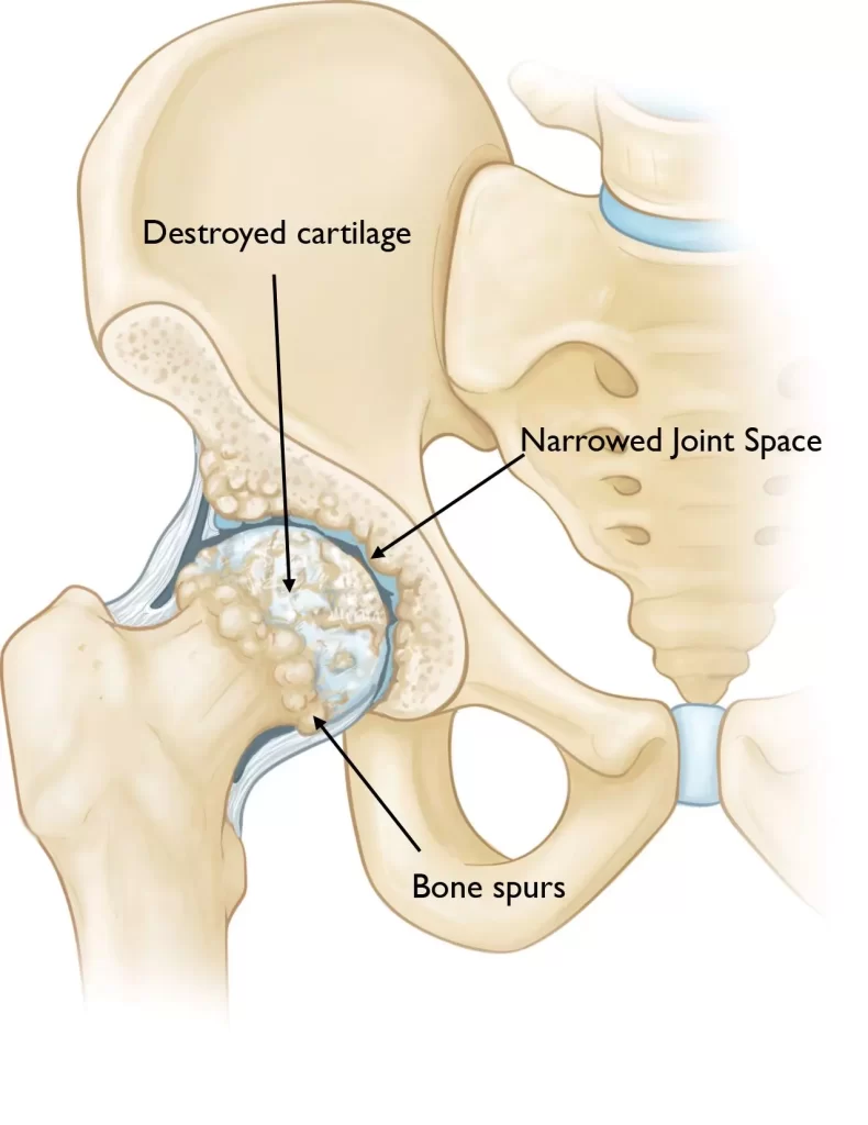 Hip Arthritis | Orchard Health Clinic