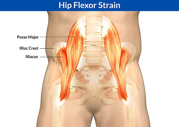 Illustration of Hip Flexor Tear/ Strain | Orchard Health Clinic