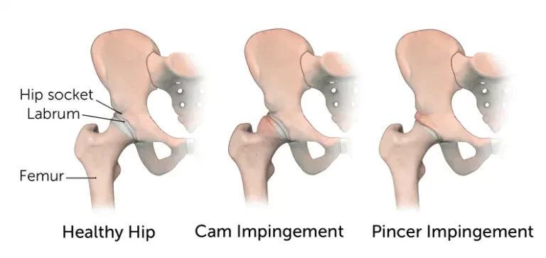 Hip Impingement | Orchard Health Clinic
