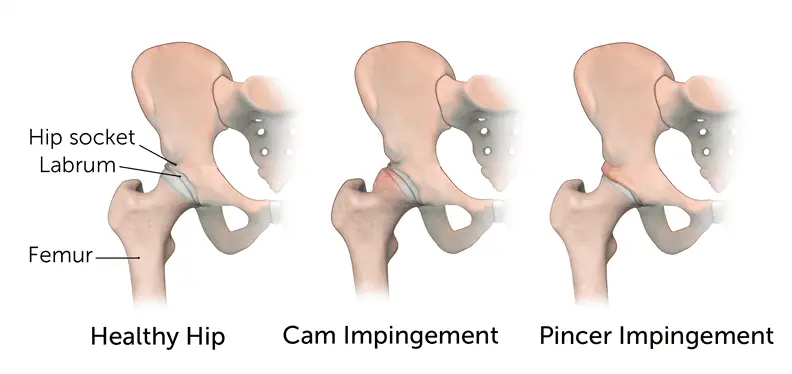 Hip Impingement | Orchard Health Clinic