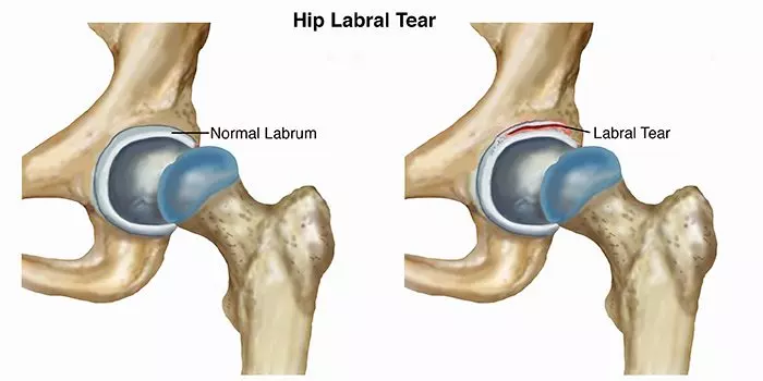 Hip Labrum Tears