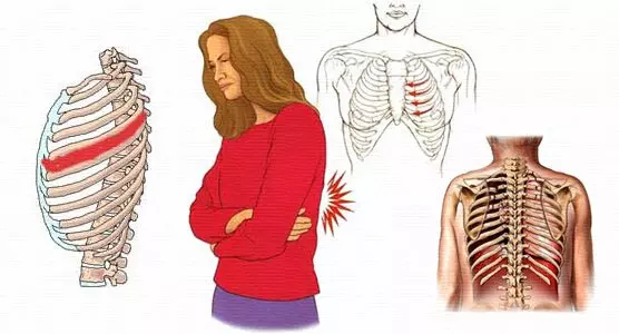Intercostal Neuralgia | Orchard Health Clinic
