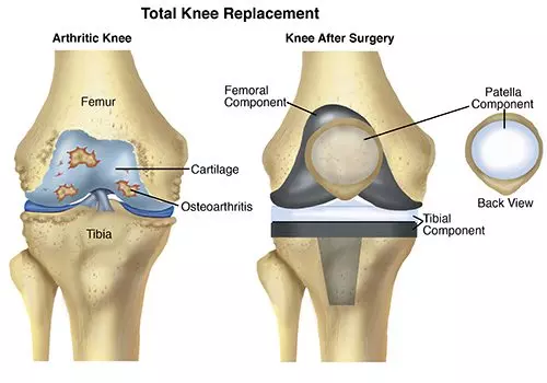 Knee Replacement (Rehabilitation)