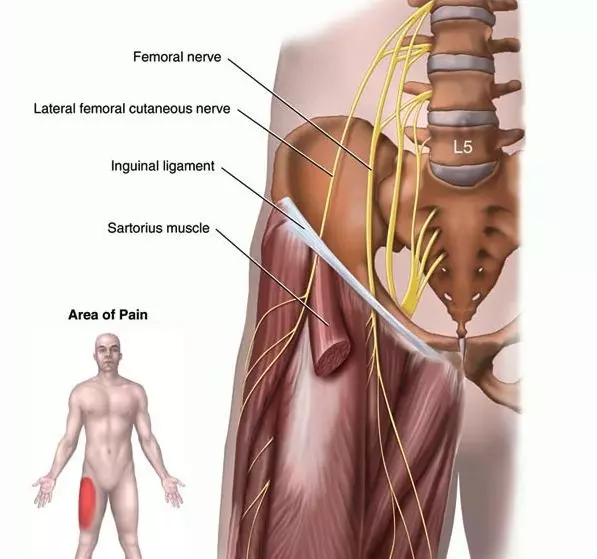 Meralgia Paresthetica | Orchard Health Clinic