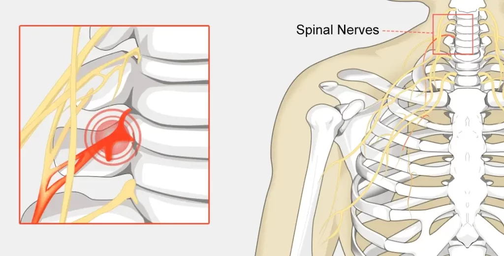 Pinched Nerve | Orchard Health Clinic