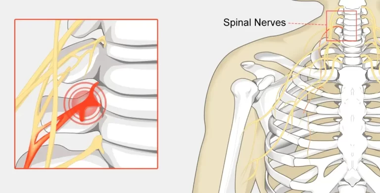 Pinched Nerve | Orchard Health Clinic