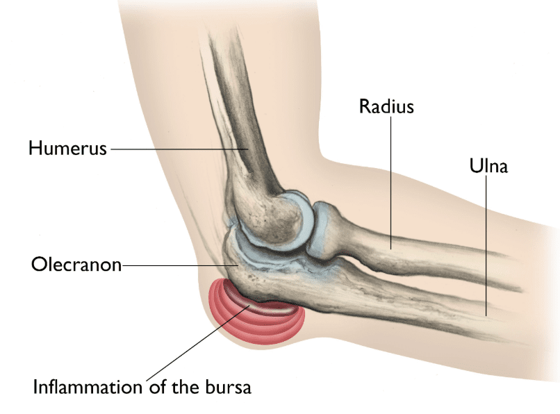 illustration of elbow showing inflamtion of bursa