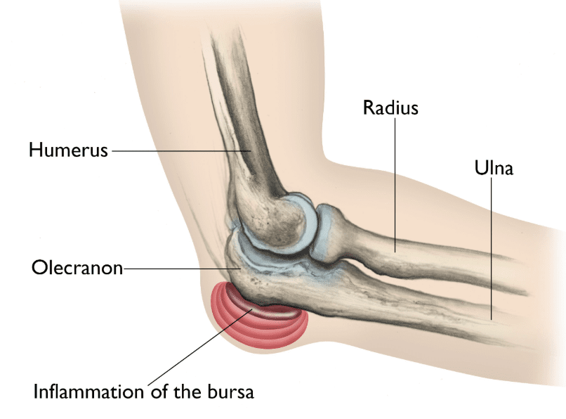 Illustration of Elbow Showing Inflamtion of Bursa | Elbow Bursitis