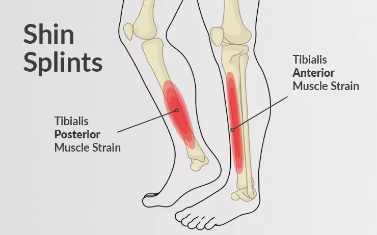 Shin Splints | Orchard Health Clinic
