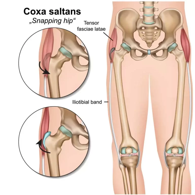 Snapping Hip Syndrome