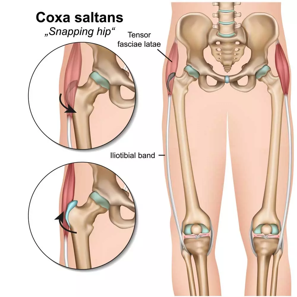 Snapping Hip Syndrome | Orchard Health Clinic