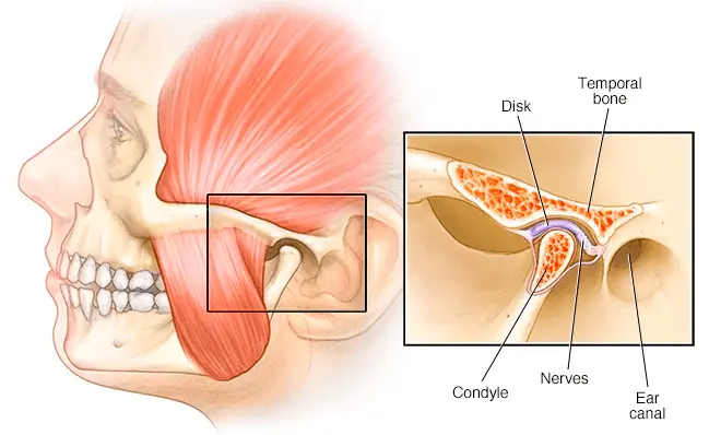 Temporomandibular Joint (TMJ) Dysfunction