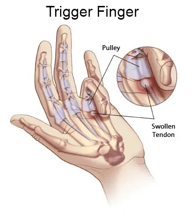 Trigger Finger | Orchard Health Clinic