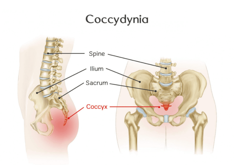 Image of Coccydynia (Tailbone Pain) | Orchard Health Clinic