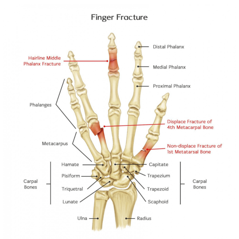 Finger and Hand Fractures | Orchard Health Clinic