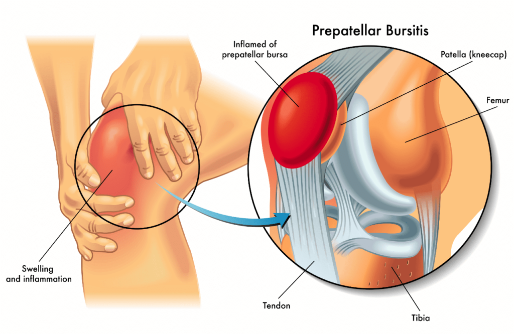 image of knee-bursitis