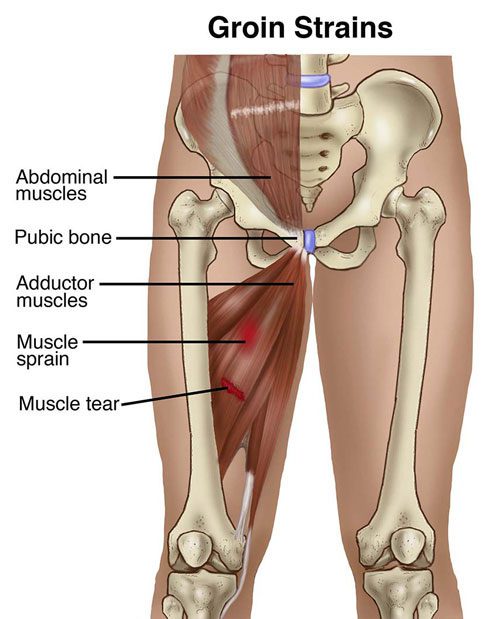 Groin Strain - Orchard Health Clinic - Osteopathy, Physiotherapy