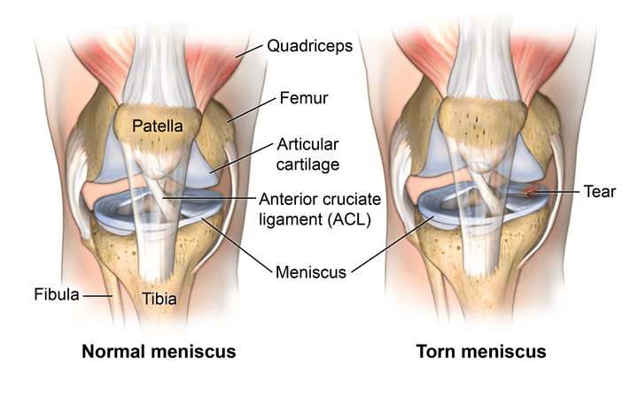 diagram of knee-meniscus-problems