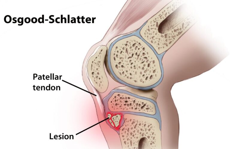 Image of Osgood-Schlatter Disease | Orchard Health Clinic