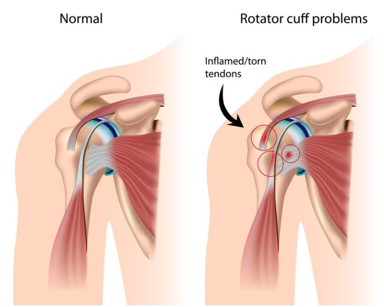 Blood Cell Types | Rotator Cuff Injuries